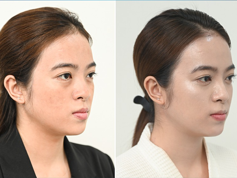 aqua-clinic-ra-mat-cong-nghe-cang-bong-da-hien-dai