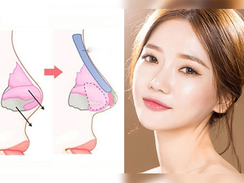 ban-giai-phap-sua-mui-hong-bang-ung-dung-sun-surgiform