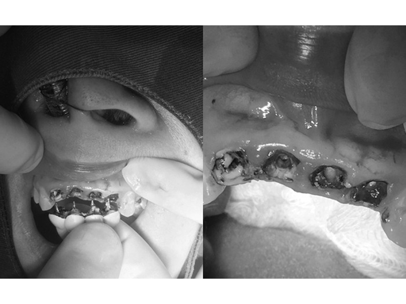 boc-rang-su-cho-xinh-co-gai-26-tuoi-mun-het-rang-cua