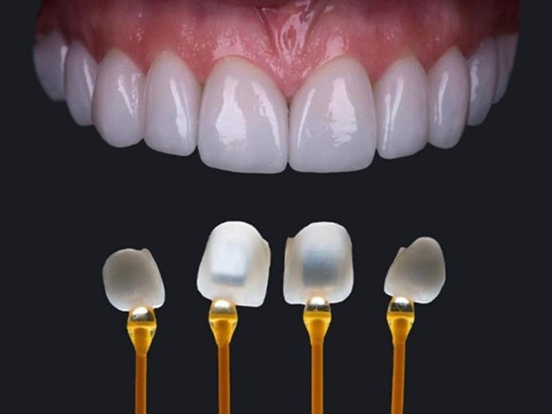 can-chu-y-gi-khi-dan-su-veneer