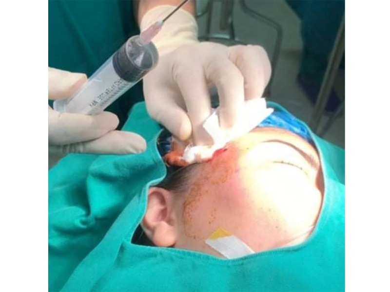 gan-chuc-ca-tai-bien-tiem-filler-trong-nua-thang