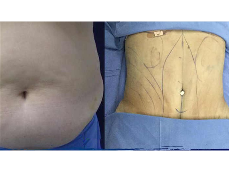 khong-xac-dinh-duoc-nguyen-nhan-nguoi-phu-nu-tu-vong-sau-hut-mo-bung