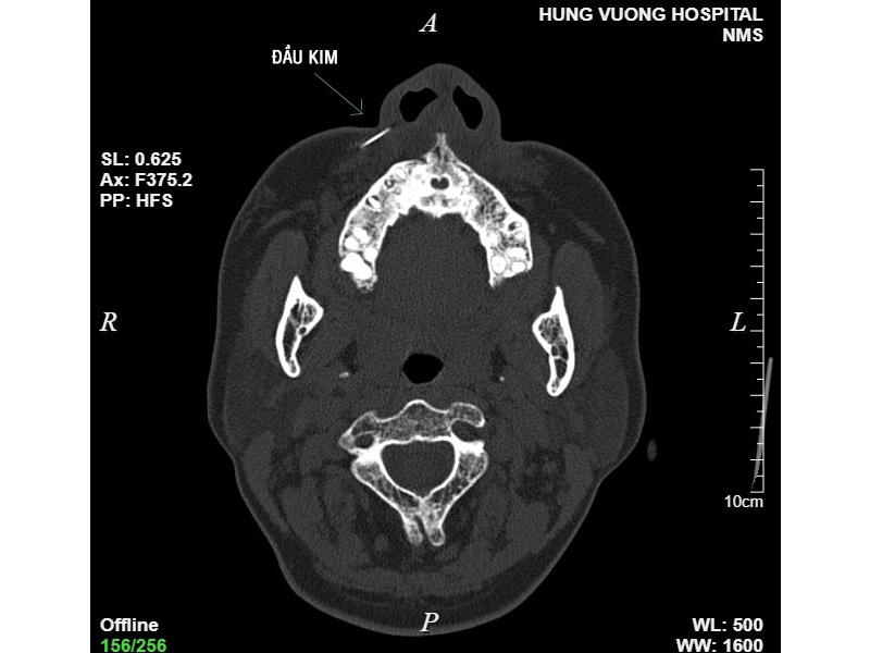 kim-tiem-gay-mac-trong-ma-nguoi-phu-nu-khi-tiem-filler-tai-salon-toc-ha-noi