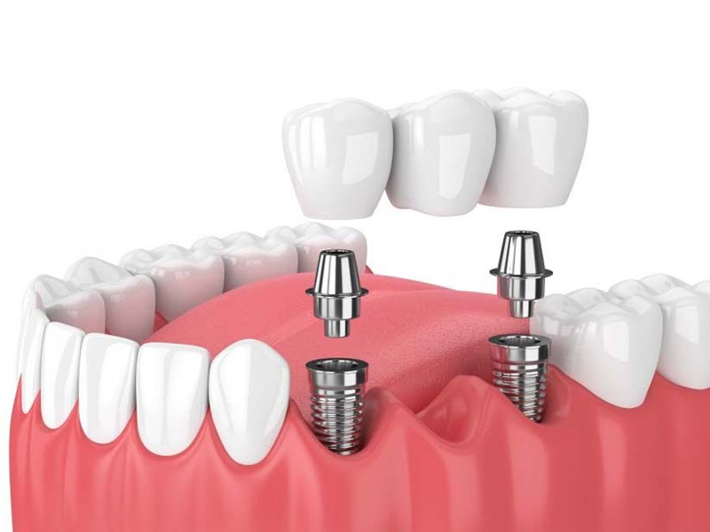 luu-y-cho-kieu-bao-khi-trong-rang-implant-o-viet-nam