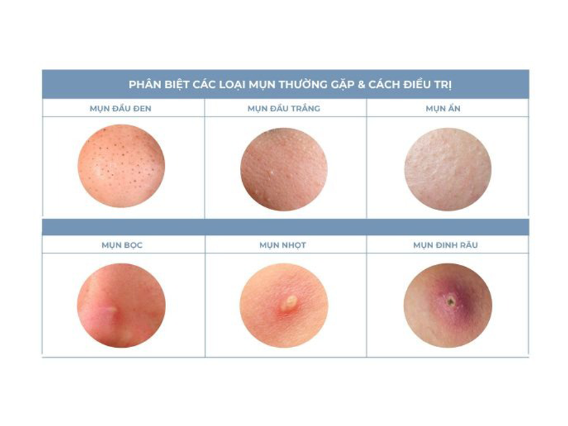 mun-co-bao-nhieu-loai-dieu-tri-tung-loai-nhu-the-nao-la-dung-cach