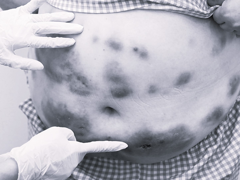 nguoi-phu-nu-bi-hoai-tu-vung-bung-sau-khi-tiem-tan-mo