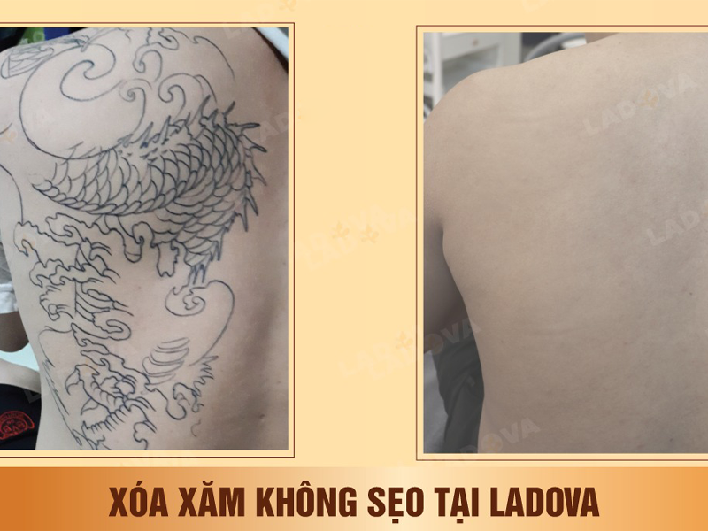 vien-tham-my-ladova-xoa-xam-khong-seo-sach-muc-bang-laser