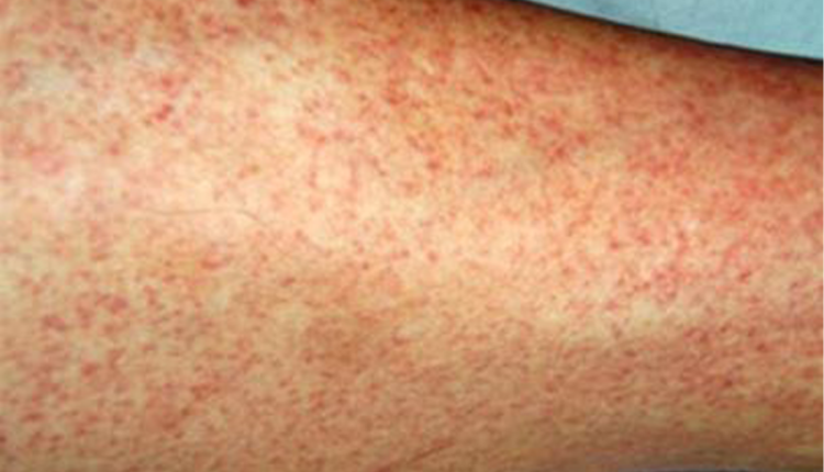 ban-soi-o-tre-em-va-nguoi-lon-nhan-biet-dung-phong-ngua-som-de-bao-ve-suc-khoe