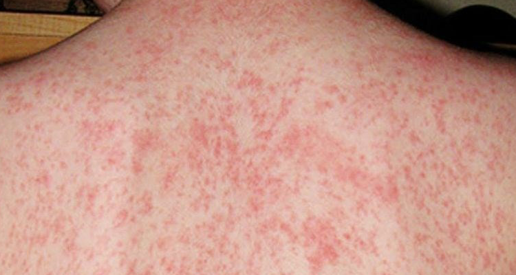 benh-soi-hien-nay-voi-nhieu-dien-bien-phuc-tap