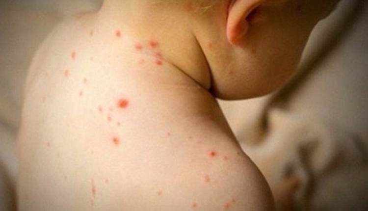 benh-soi-o-tre-em-nhung-dieu-cha-me-can-biet-de-bao-ve-con-an-toan