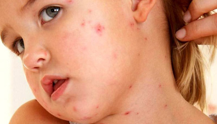 cach-phan-biet-ban-soi-va-sot-phat-ban-hieu-dung-de-cham-soc-va-phong-benh-hieu-qua